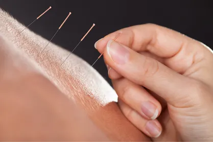 Acupuncture Etobicoke